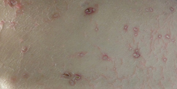 Degos Disease (Malignant Atrophic Papulosis, Köhlmeier-Degos Disease)