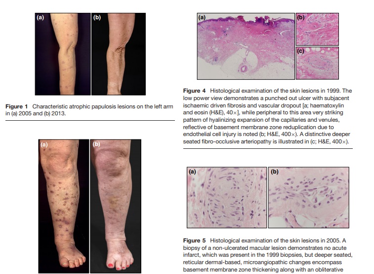 Benign atrophic papulosis – The wedge-shaped dermal necrosis can resolve with time